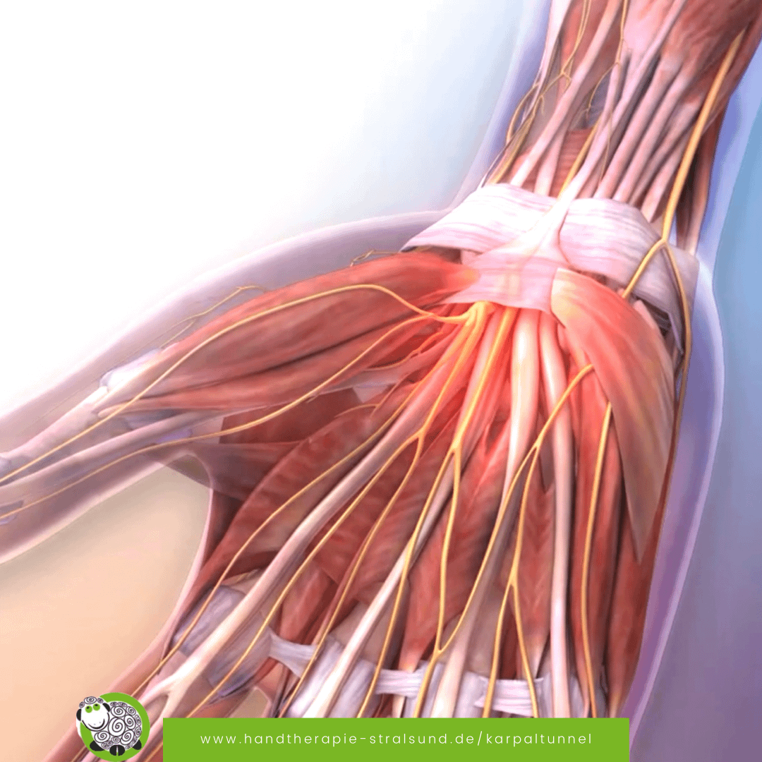 Karpaltunnelsyndrom wie lange krank?